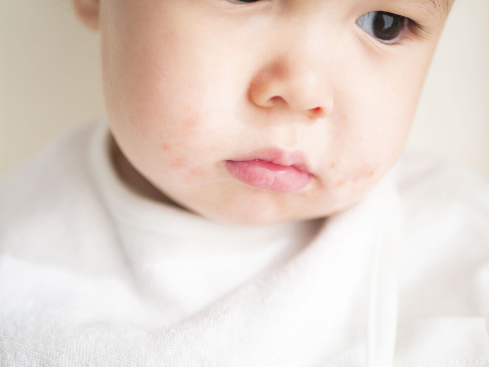 子どもの年齢別で変化する、症状の出やすい部位の特徴